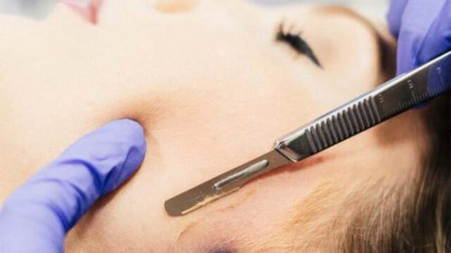 A close-up of a person’s face as a gloved hand uses a scalpel to remove fine hair or skin, likely during a dermaplaning procedure.